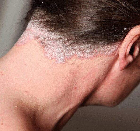 How to treat psoriasis