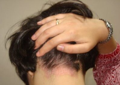 Psoriasis on his head