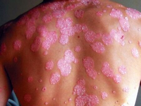 Psoriasis