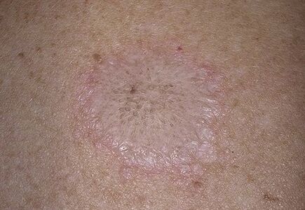 The phenomenon of stearin patch