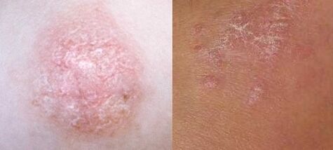 Psoriasis in the initial stages