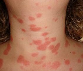 The phenomenon of stearin patch